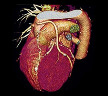 Coronary CT Angiography