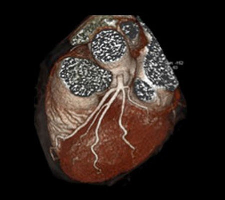 Coronary CT Angio